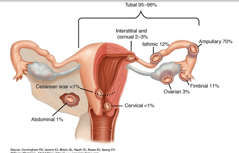 tubal pregnancy diagram