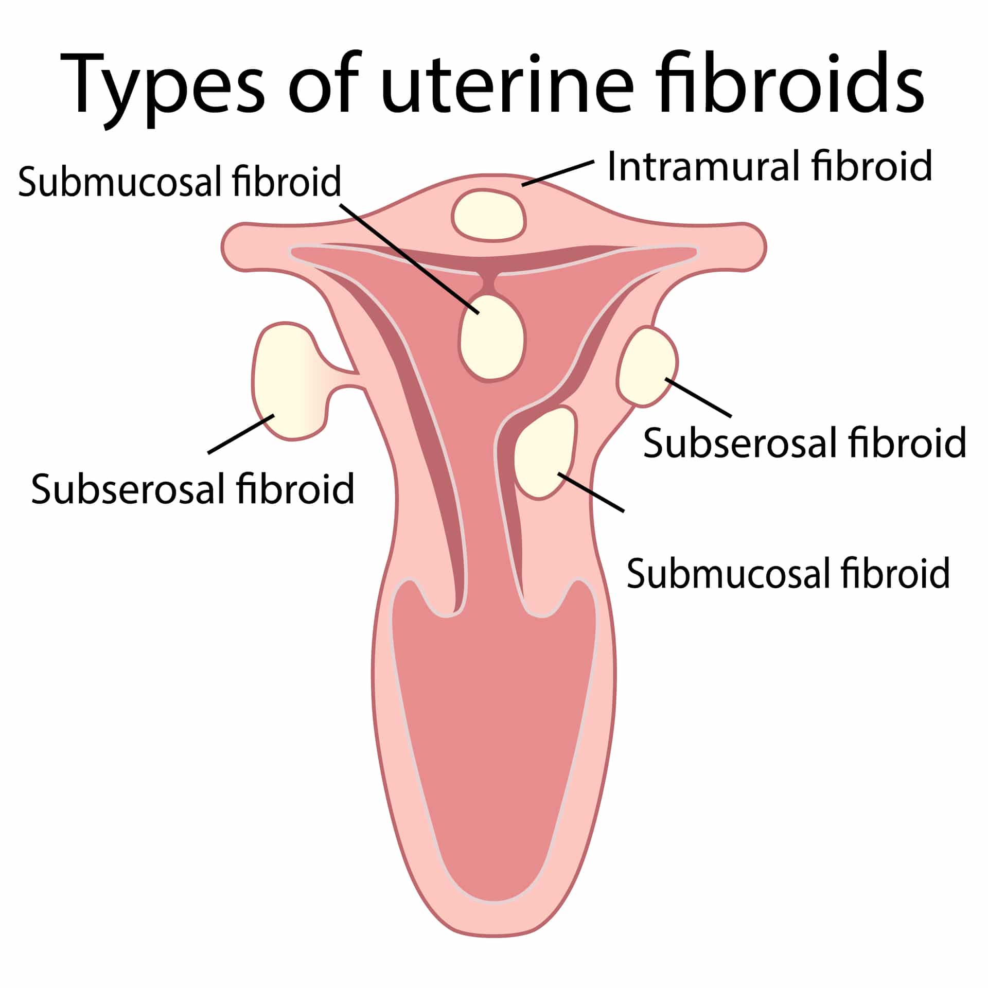 Fibroid Treatment And Management | ParkMed NYC Health Services